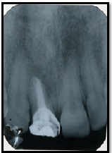 Scalpel Depigmentation and Crown Lengthening to Improve Anterior Esthetics with Zirconia Crown: A Case Report