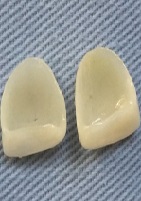 Guidelines for Restoring Fractured Central Incisors
