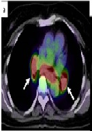 Sarcoidosis as Hepatic, Splenic, and Para-aortic Lymph Nodules, Mimicking Colon Cancer Metastases: A Case Report