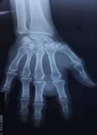 Juxta Articular Myxoma of the Hand: A Case Report and Review of the Literature