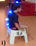 Postural Control in Preschool Children with Developmental Coordination Disorder, in Sitting Position During a Functional Task