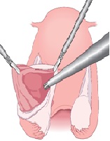 Surgical Management of Endometriomas: The Link Between Pathophysiology and Technique