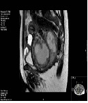 Degenerative Cervical Leiomyoma Resembling Malignant Leiomyosarcoma