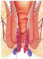 Preliminary Experience with PPH(Hemorrhoidopexy) At Butaro Hospital Rwanda