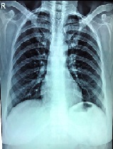 Laparoscopic Repair of Diaphragmatic Hernia in the Adult: A Case Report & Review of Literature