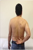 Coraco-Glenoid Chondrosarcoma Glenoid Resection and Reconstruction with an External Tibial Plateau Osteochondral Allograft