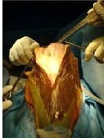 Patelloplasty in Total Knee Arthroplasty with Circumpatellar Denervation Versus without Denervation - A Randomized Prospective Trial