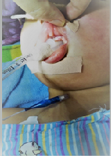 Simplified Assessment of Pressure Ulcer Risk in Hospitalized Children: Development of The Pediatric Pressure Ulcer Trigger Tool (PPUTT)