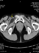 Laparoscopic Transabdominal Preperitoneal Repair for Recurrent Obturator Hernia: A Case Report