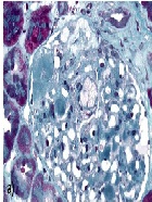 Glomerulopathy Associated with Lecithin-Cholesterol-Acyltransferase Deficiency: A Case Report and Literature Review