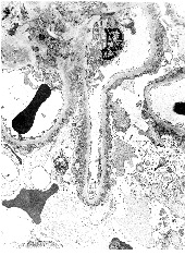 Laparoscopic Bilateral Nephrectomy Followed by Live-Related Kidney Transplant for the Treatment of Persistent Severe Nephrotic Syndrome and Advanced Chronic Renal Failure: A Case Report and Review of the Literature