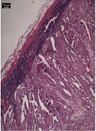 Dynamic Ultra-Deep Sequencing of Mutant Epidermal Growth Factor Receptor in a Non-Small Cell Lung Cancer Patient