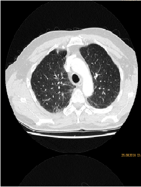Synchronous Pneumonitis, Hepatitis and Enteritis Under Treatment with PI3kδ Inhibitor Idelalisib for Follicular Lymphoma