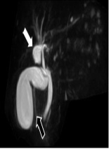 Intrahepatic Bile Duct Cyst Calculus and Gallbladder Stones Treated with Surgery: A Case Report