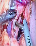 Laparoscopic Liberation of Celiac Artery in Median Arcuate Ligament Syndrome in Infant: A Case Report and Literature Overview