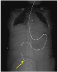 Healing One Acute Pancreatitis Patient with the Duodenal Perforation Caused by a Nutritional Tube Misplacement