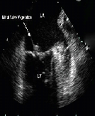 Atypical Presentation of Infective Endocarditis: A Case Report