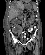 Sarcomatoid Renal Cell Carcinoma in a Renal Allograft