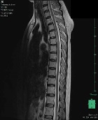 A Case of Collaborative Practice Rehabilitation in Transverse Myelitis Complicated with Idiopathic Interstitial Pneumonia