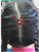 Braids or Pony-tail-associated Traction Alopecia in Female Children