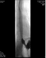 Gastric Pacing for Severe Gastroparesis during Pregnancy