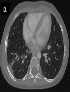 One-lung Ventilation in a Child with Hyper-IgE Syndrome