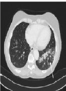 Pulmonary Lymphangitis Carcinomatosis of Clear Cell Renal Cell Carcinoma After Angiogenesis Inhibition
