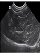 Biomathematical Analysis of the Liver Fibrosis