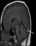 Acute Cerebral Venous Thrombosis with Papilledema and Complete Vision Loss