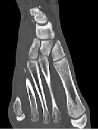 Isolated Dislocation of the Medial Cuneiform Bone: A Case Report
