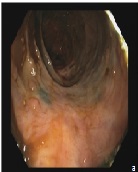 Complete Regression of the Adenomatous Polyps in a Patient affected by Familial Adenomatous Polyposis after Prolonged Administration of Phytoestrogens and Sulindac