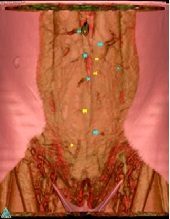 Optimising Computed Tomography Angiogram Assessment in Breast Reconstruction