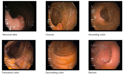 When Colonoscopy goes Wrong: A Rare Case of Splenic Rupture
