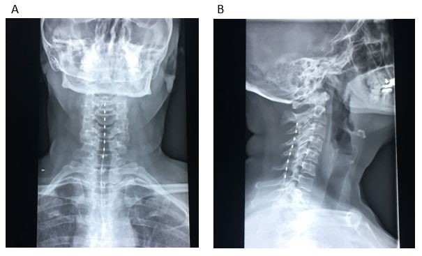 A Novel Approach with Spinal Cord Stimulation for the Treatment of Chronic Pain in Eagle’s Syndrome: A Case Report