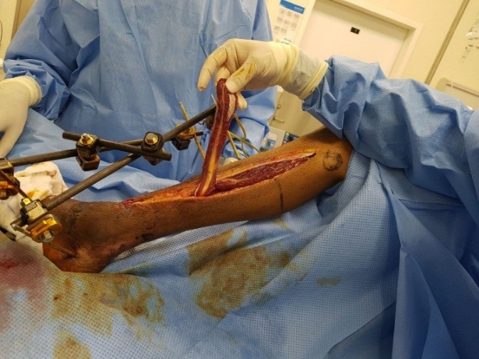 Salvageable Coverage of Ankle Defects Using Peroneus Brevis Flap