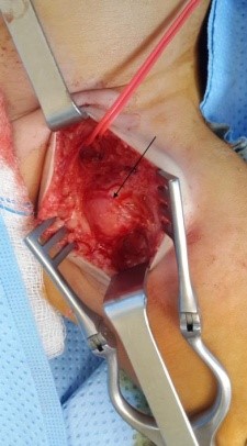 Iatrogenic False Aneurysm of the Common Femoral Artery in infants