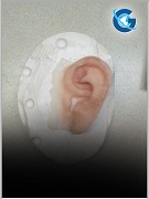 Unusual Presentation of a Large Multilocular Second Branchial Cleft Cyst