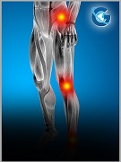 Short-and Long-Term Effects of Sclerotherapy on Chronic Tendinosis with Neovascularizationamong Sportsmen and Athletes