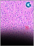 Metastatic Malignant Perivascular Epithelioid Cell Tumor (PEComa) in Parotid Gland Diagnosed by Fine Needle Aspiration Biopsy- a Case Report and Literature Review