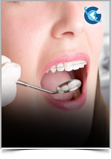 Uni-lateral Molar Distalization with Palatal Miniscrew Anchorage